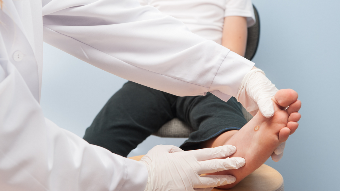 Photo of a doctor examining a patient's wart on their foot